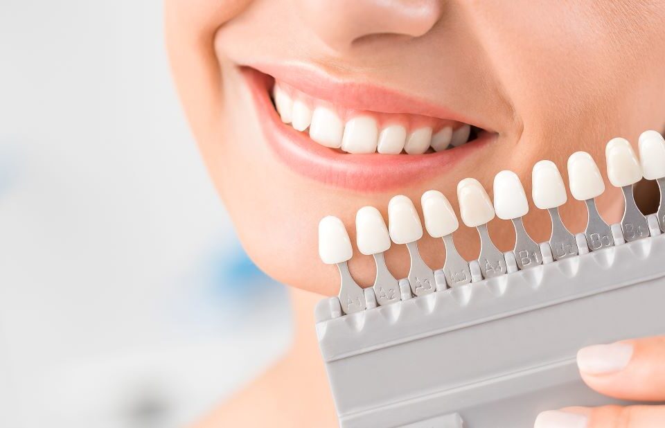 Blanchiment des dents