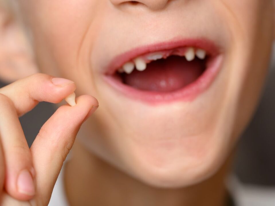 Déchaussement dentaire