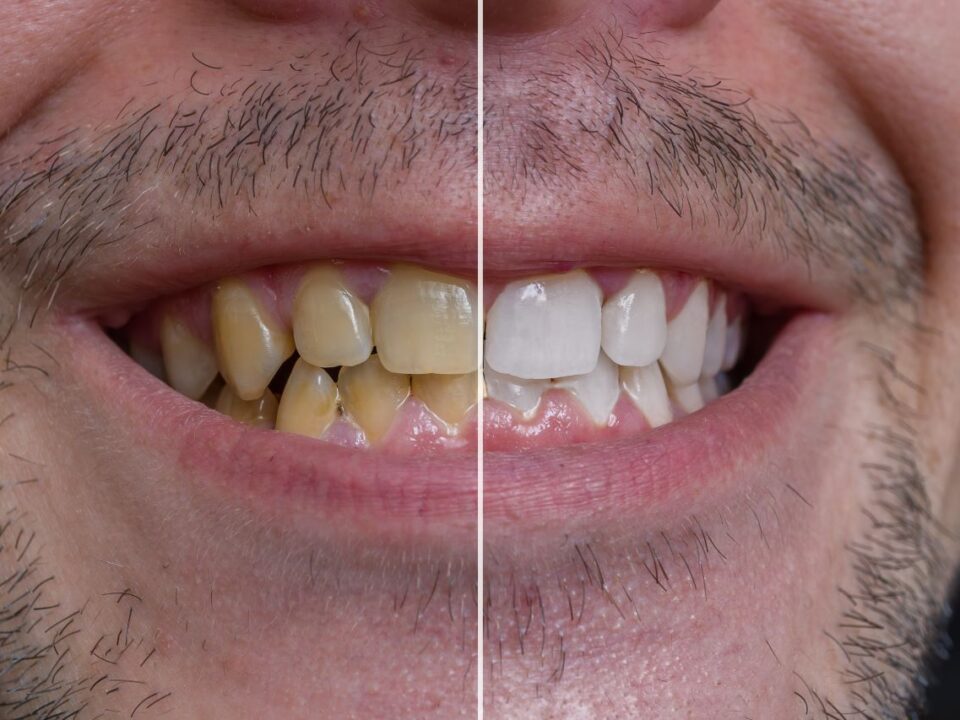 Dents jaunes : que faire ?