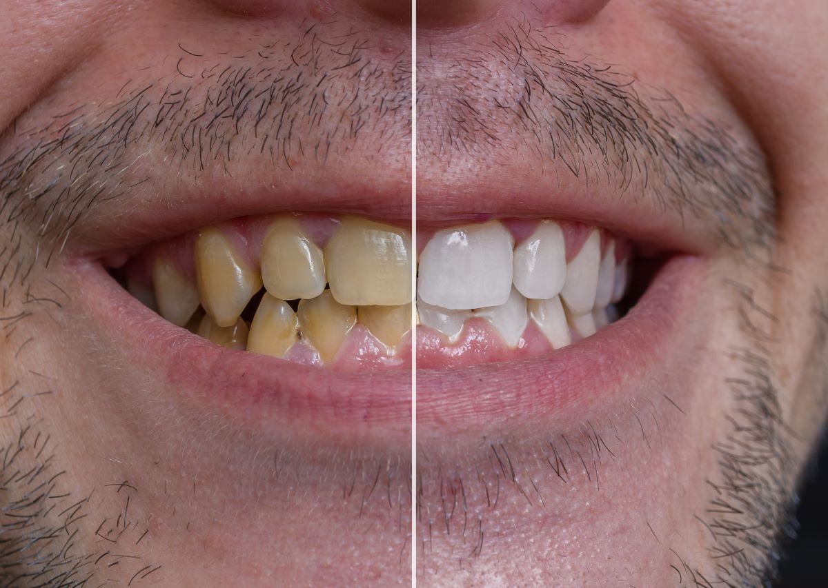 Des dents qui claquent avec Holy Grillz • Boulettes Magazine