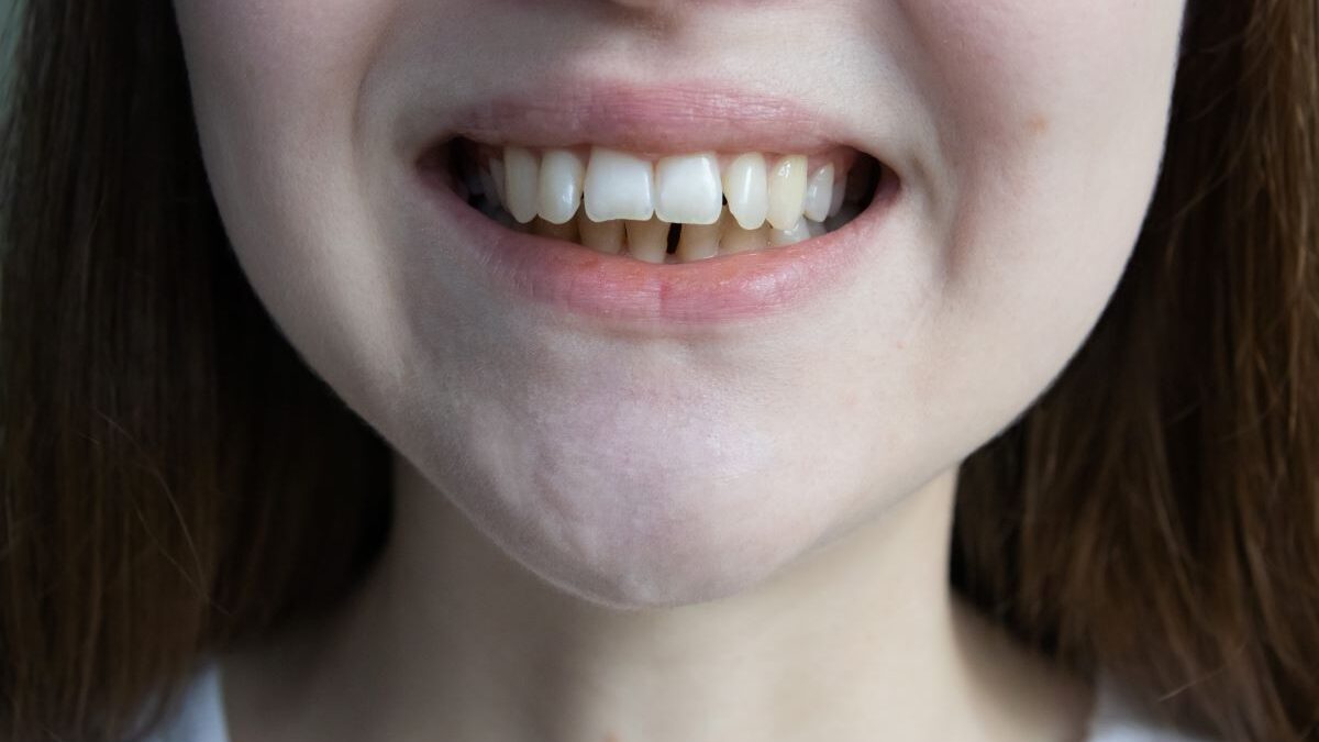 malocclusion dentaire
