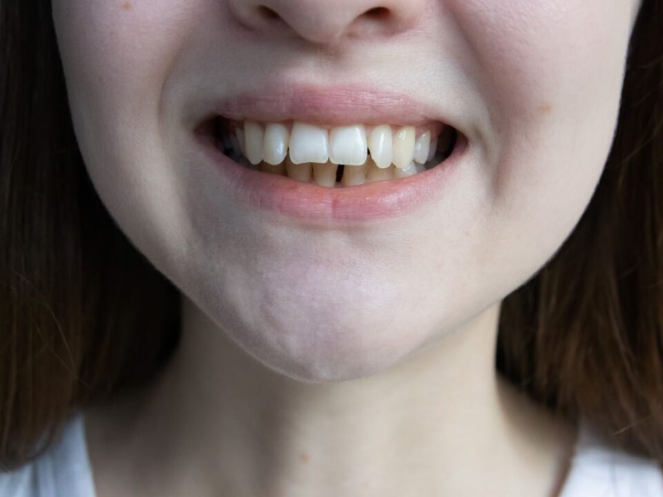 malocclusion dentaire