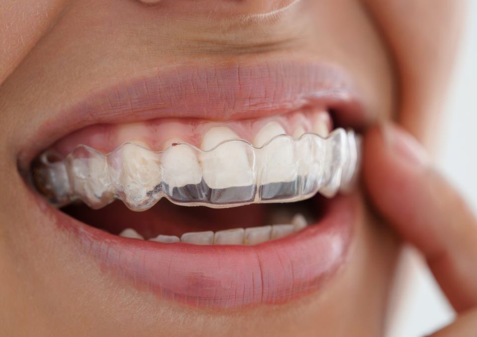 Chewing-gum et Invisalign